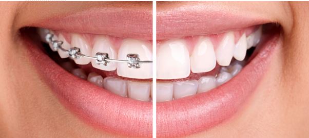 Invisalign vs Braces